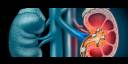 La litiasis renal