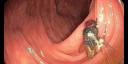 Un hombre fue a su consulta médica de rutina y encontraron una mosca viva en sus intestinos