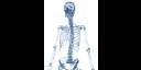 Osteogénesis imperfecta (OI), comúnmente conocida como «huesos de cristal»