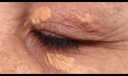 ¿Qué podrían decir las manchas alrededor de los ojos sobre tu salud?