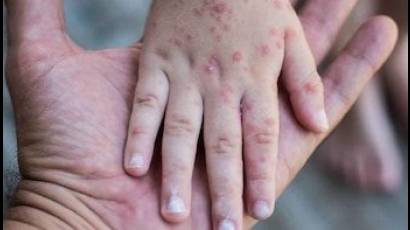 El sarampión es tan contagioso que se necesita llegar a al menos 90 por ciento de cobertura en la vacuna para controlar la propagación
