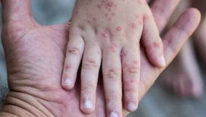 El sarampión es tan contagioso que se necesita llegar a al menos 90 por ciento de cobertura en la vacuna para controlar la propagación